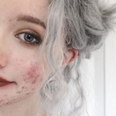 Girl’s before-and-after acne photos encourage others to not be ashamed
