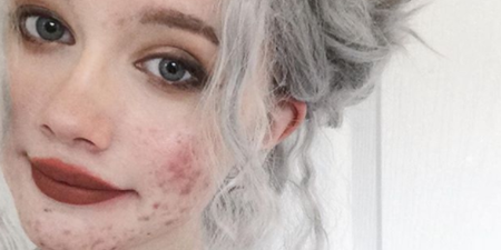 Girl’s before-and-after acne photos encourage others to not be ashamed