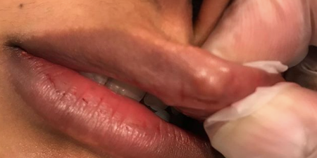 Celeb surgeon Dr Esho shares graphic video of how lip fillers can go wrong