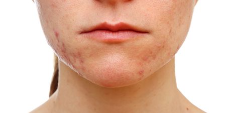 Scientists have created a vaccine that could cure acne forever