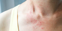 Suffering from eczema? Here are 6 ways to naturally soothe your skin