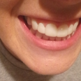 I wore clip-in veneers for a day – here’s what I really thought
