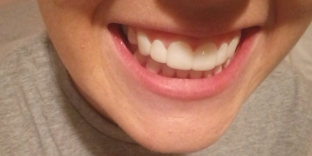 I wore clip-in veneers for a day – here’s what I really thought