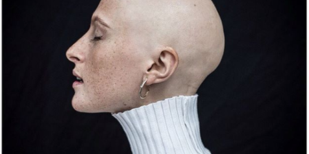 Stunning Irish model with alopecia covers magazine totally hair-free