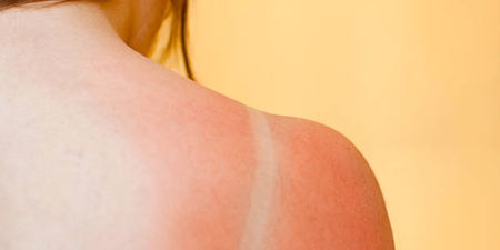 Woman claims her 30-minute shaving foam hack will help get rid of sunburn