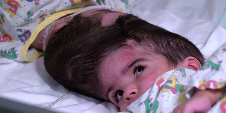 Conjoined twins successfully separated following 50 hour surgery in London