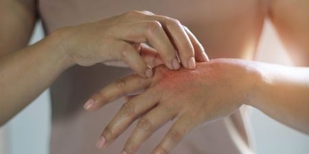 Psoriasis Awareness Month: Top 10 questions about the skin condition answered