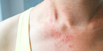 September is Eczema Awareness Month, and here’s what you should know