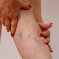 Varicose veins and women: How do you recognise them and can you avoid them?