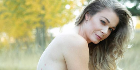 “80% of my body was covered:” LeAnn Rimes on life-long Psoriasis battle