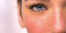 Rosacea awareness month: 3 skincare products many rosacea sufferers swear by