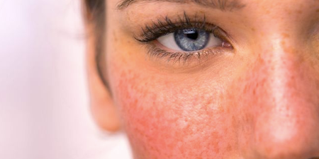 Rosacea awareness month: 3 skincare products many rosacea sufferers swear by