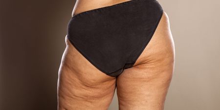 Cellulite is completely normal – but why do we get it?