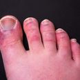 Did you get ‘Covid toes?’ Research shows new side effect of virus