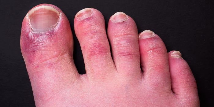 A foot with red, swollen toes.
