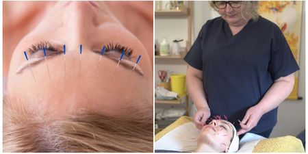 Like botox, but all natural: I tried cosmetic acupuncture and here’s what happened