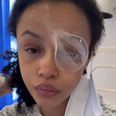 Alanna Quinn Idris undergoes third surgery to repair eye socket after horrific attack