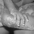 Only a matter of time before monkeypox spreads to Ireland, says expert