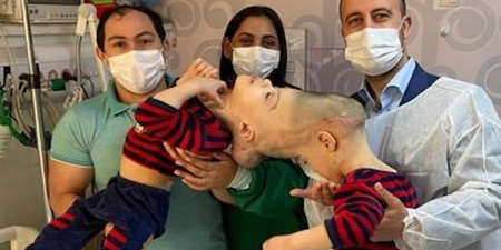 Conjoined twins with fused brains have been successfully separated