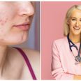 Dr Doireann O’Leary’s top tips on managing acne prone skin and breakouts