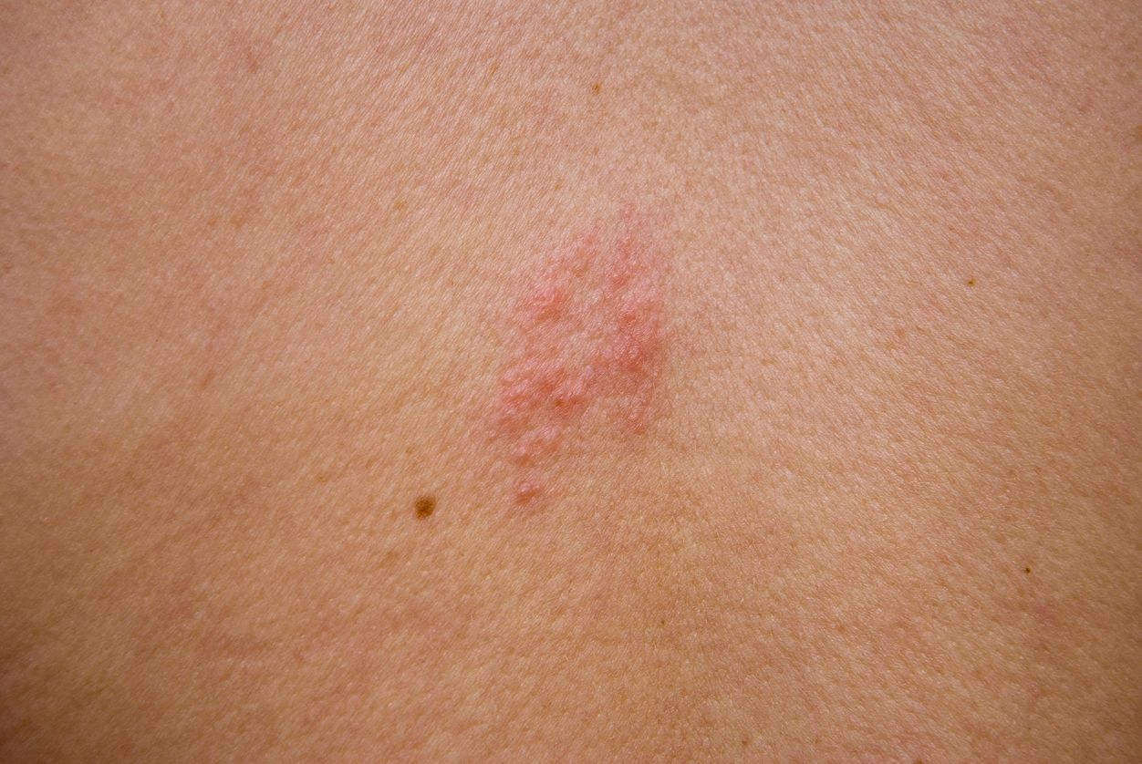 HSE issues warning to the public about painful shingles virus