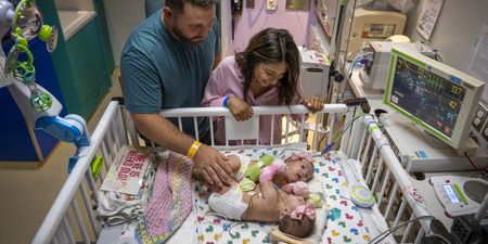 Conjoined twins return home after successful separation surgery