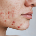 Can having acne impact your mental health? What researchers have discovered