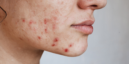 More than skin deep: Clearing my acne is boosting my self-worth again