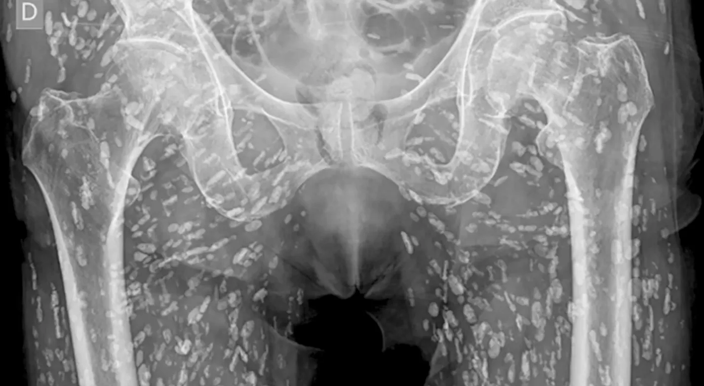 Horrifying X-ray shows tapeworms breeding inside man’s body after he made vital kitchen error