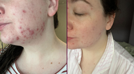 The cleanser that finally started to clear up my cystic acne
