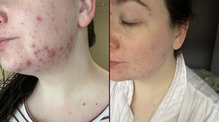 The cleanser that finally started to clear up my cystic acne