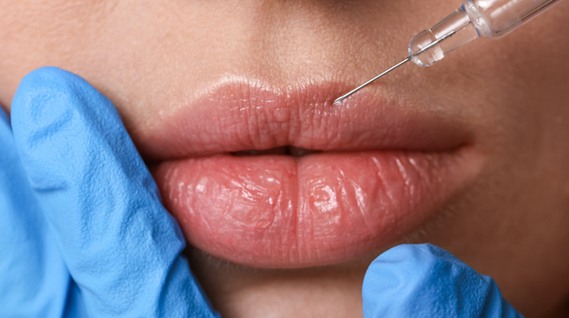 Lip Filler