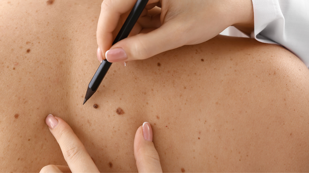 Skin Cancer Rates