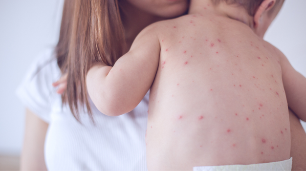 Measles Outbreak
