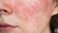 Rosacea sufferers need to try this anti-inflammatory serum