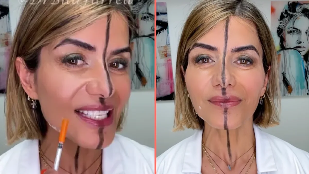 Doctor shares side effects of Botox after injecting only one side of her face - Her.ie