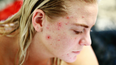 Irish skincare expert reveals what actually causes adult acne