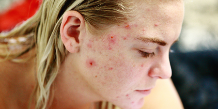 Irish skincare expert reveals what actually causes adult acne