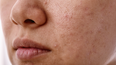 Thousands are buying this K-beauty blackhead remover and it's currently on sale