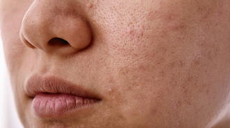 Thousands are buying this K-beauty blackhead remover and it’s currently on sale